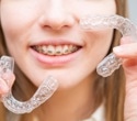 Clear aligners protect oral microbiome better than fixed braces