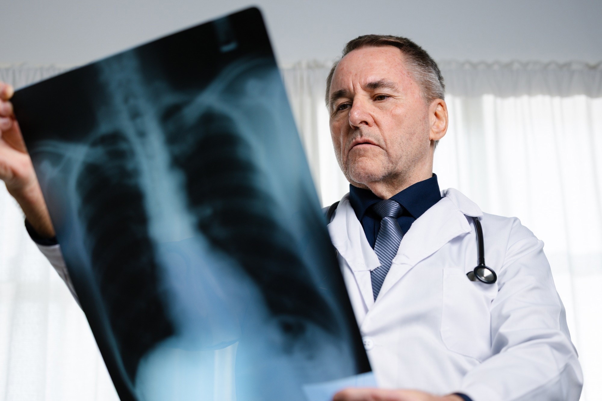 Opinion: Lung cancer in never smokers: from early detection to prevention. Image Credit: Thx4Stock team / Shutterstock