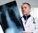 Why lung cancer in never smokers is rising and how targeted detection could reduce deaths