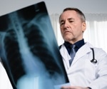 Why lung cancer in never smokers is rising and how targeted detection could reduce deaths