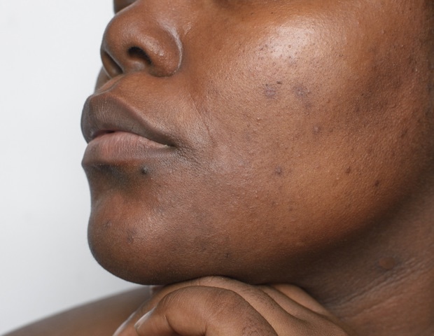 Skin of color seminar improves medical students’ diagnosis skills