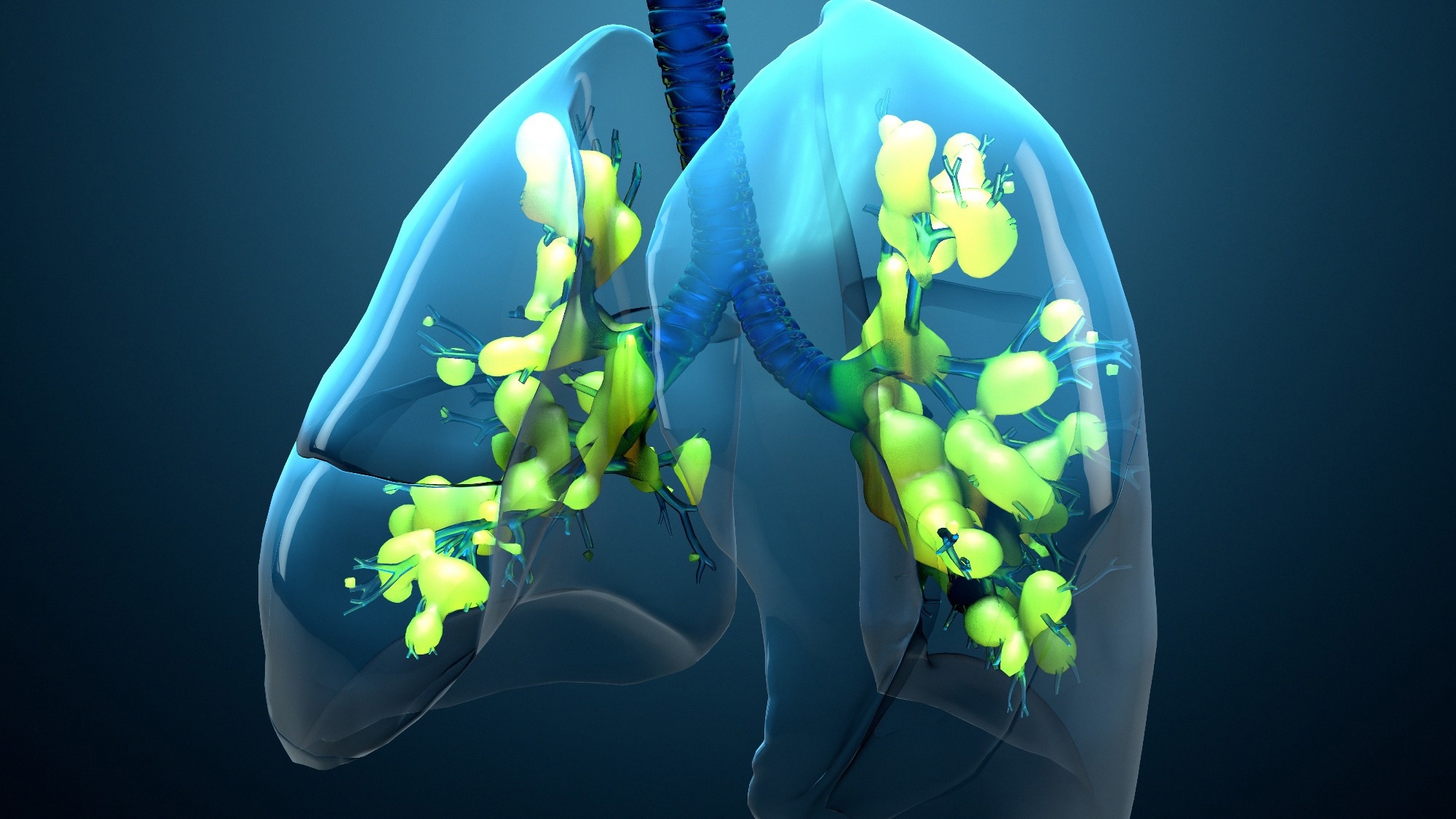 Study: Four year mortality and quality of life after ICU treatment for COVID 19 related acute respiratory distress syndrome. Image Credit: Design_Cells / Shutterstock