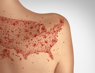 Why measles remains one of the most contagious viral diseases worldwide