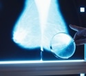 AI model flags hidden breast cancers years before diagnosis in routine mammograms