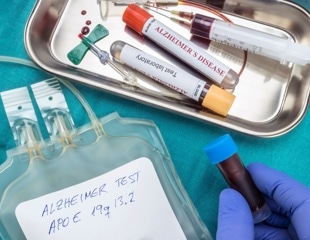 Blood protein structure changes may enable earlier detection of Alzheimer’s