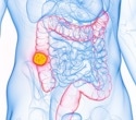 Tumor debulking fails to improve survival in colorectal cancer