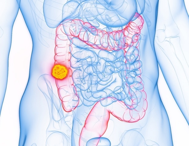 Tumor debulking fails to improve survival in colorectal cancer