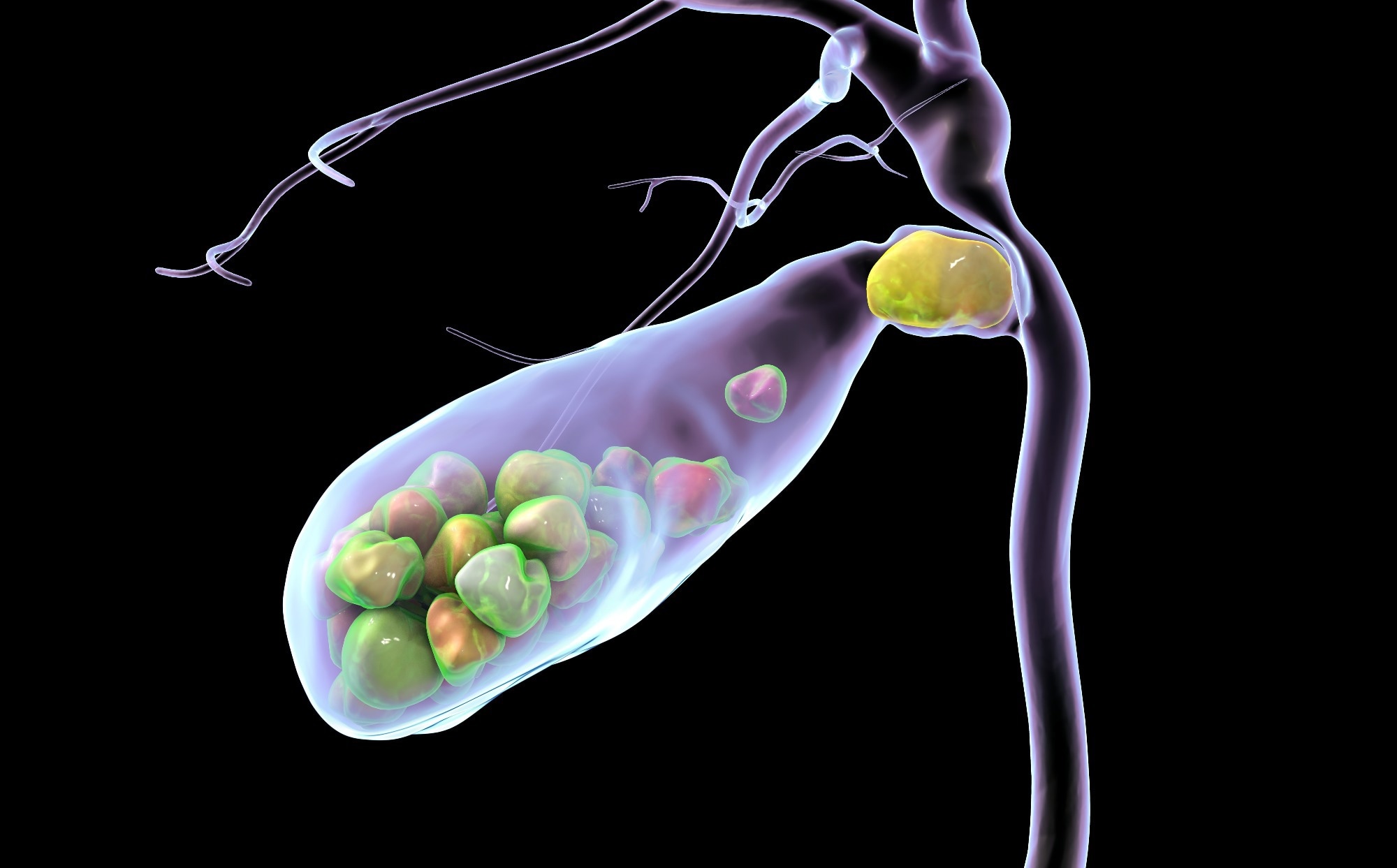 Higher Sugar Intake Raises Gallstone Risk In Adults, Study Finds