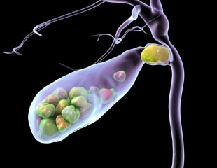 Higher sugar intake raises gallstone risk in adults, study finds