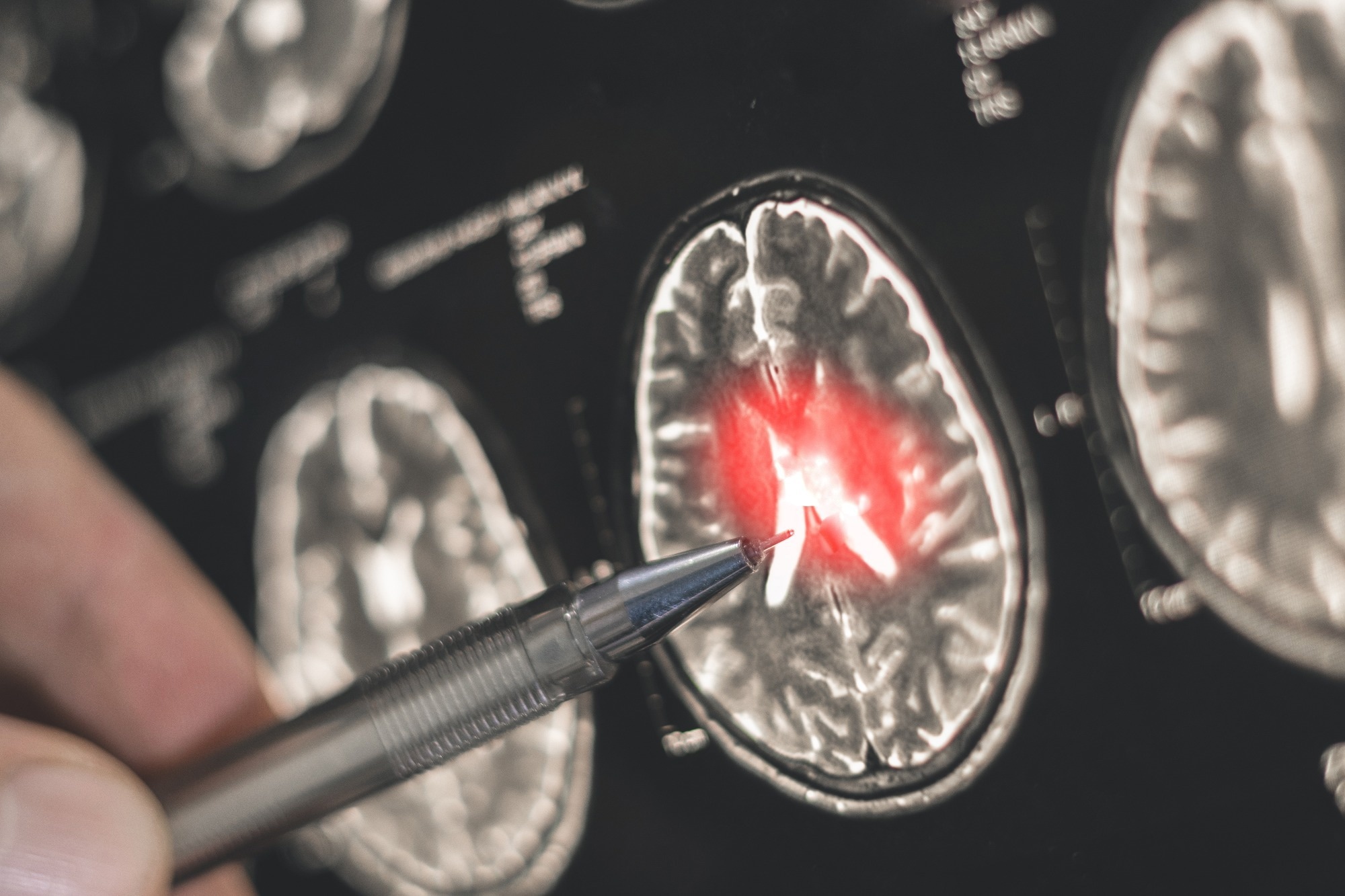 Study: Risk of Alzheimer Dementia After High-Dose vs Standard-Dose Influenza Vaccination. Image Credit: Only_NewPhoto / Shutterstock