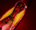 Evolocumab trial could reshape how doctors treat high-risk cholesterol patients