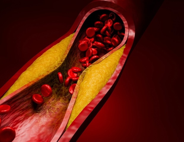Evolocumab trial could reshape how doctors treat high-risk cholesterol patients