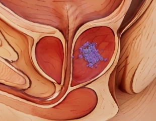 Metformin boosts an exercise-linked metabolite and may help control weight in prostate cancer patients