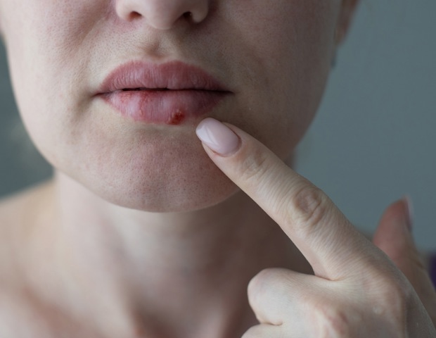 Antiviral drugs and shingles vaccines tied to lower dementia risk