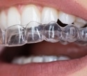 Cola may quickly lower pH inside orthodontic clear aligners and shift oral bacteria within hours