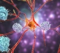 Alzheimer’s monoclonal antibodies fail to deliver meaningful results