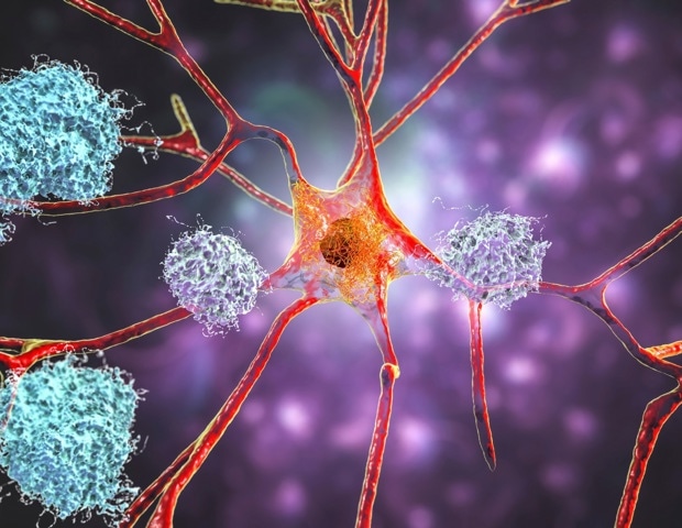 Alzheimer’s monoclonal antibodies fail to deliver meaningful results