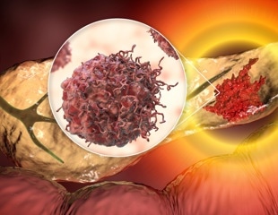 Why do the deadliest cancers still get less NIH research funding?