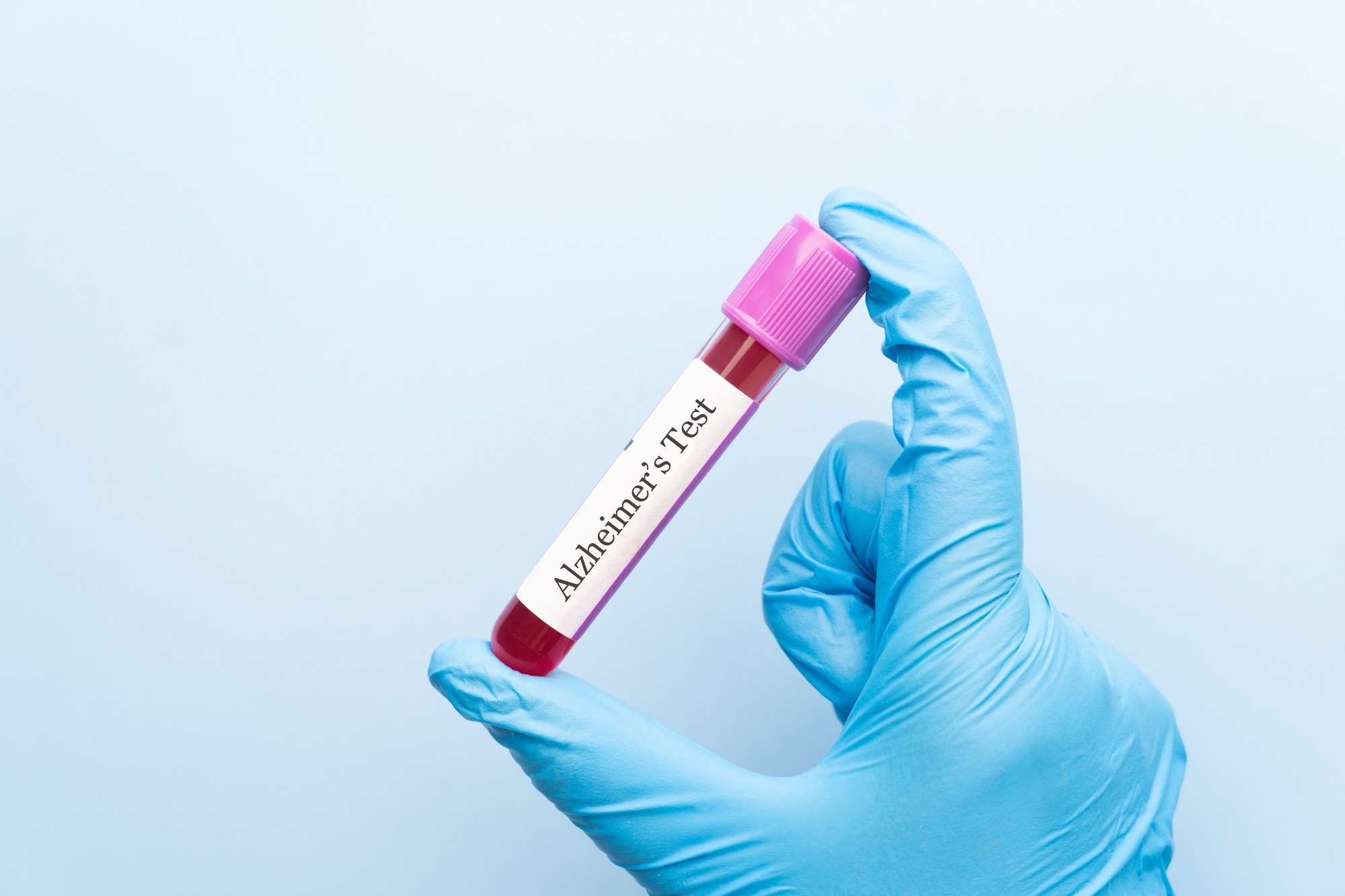 Identifying the ages when Alzheimer’s biomarkers sharply change