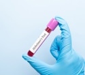 Identifying the ages when Alzheimer’s biomarkers sharply change