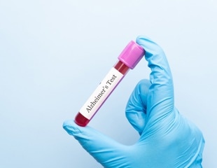 Identifying the ages when Alzheimer’s biomarkers sharply change