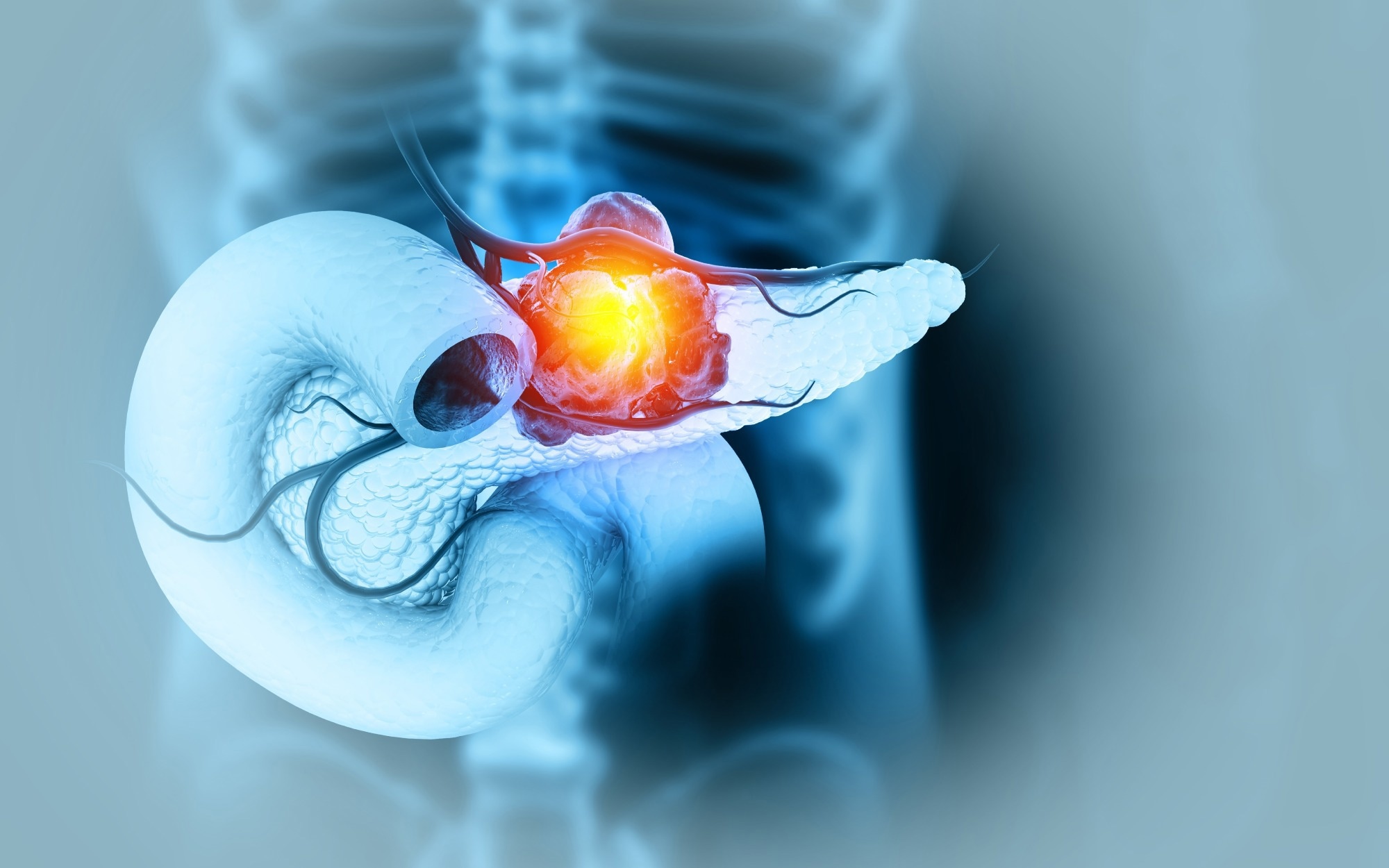 New AI model spots hidden pancreatic cancer long before diagnosis