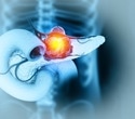 New AI model spots hidden pancreatic cancer long before diagnosis