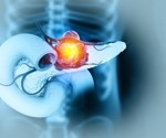 New AI model spots hidden pancreatic cancer long before diagnosis