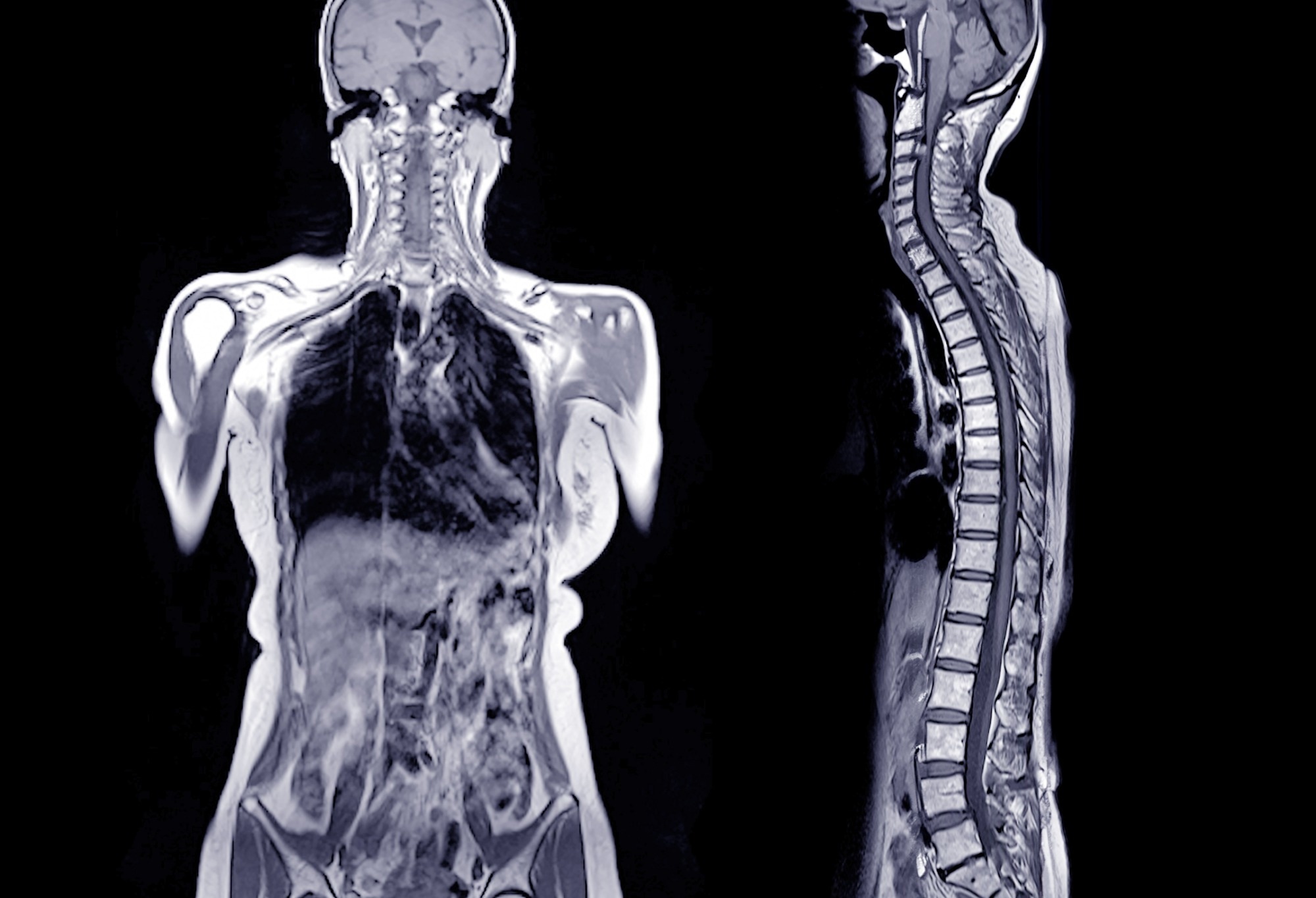MRI whole body scan image