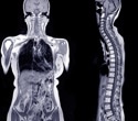 AI-powered MRI scans predict diabetes and heart disease risk