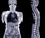 AI-powered MRI scans predict diabetes and heart disease risk