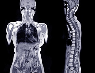 AI-powered MRI scans predict diabetes and heart disease risk