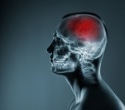 Brain artery widening may drive lacunar stroke more than artery narrowing