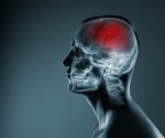 Brain artery widening may drive lacunar stroke more than artery narrowing