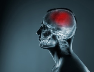 Brain artery widening may drive lacunar stroke more than artery narrowing