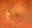 AI eye scans reveal who may be at higher risk of osteoporosis