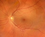 AI eye scans reveal who may be at higher risk of osteoporosis