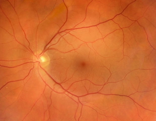 AI eye scans reveal who may be at higher risk of osteoporosis