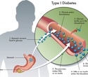 New therapies could help type 1 diabetes care move beyond insulin alone