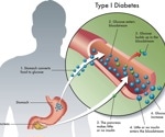 New therapies could help type 1 diabetes care move beyond insulin alone