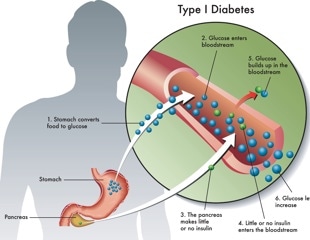 New therapies could help type 1 diabetes care move beyond insulin alone