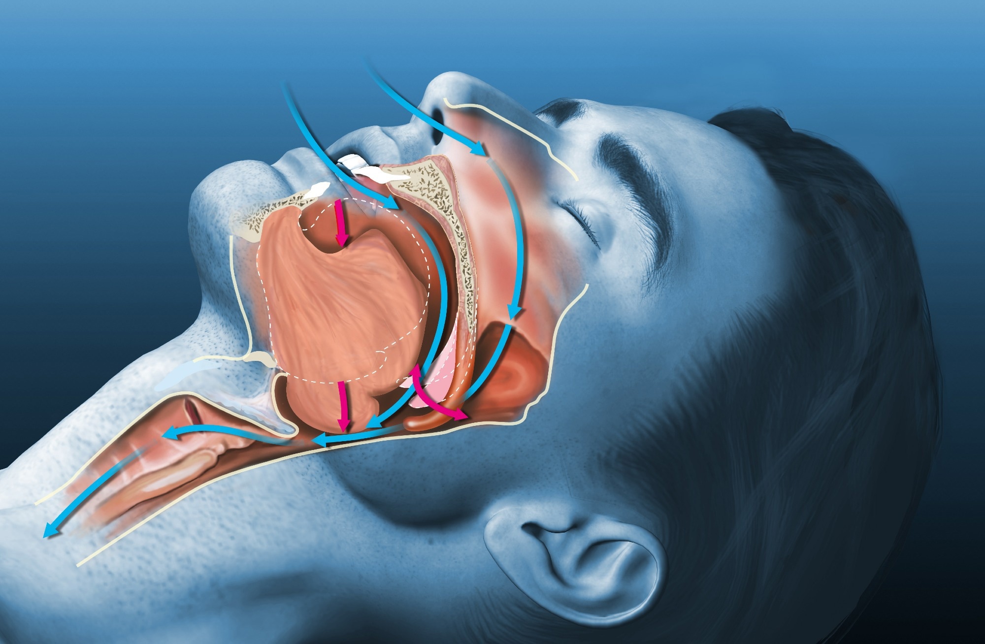 Study: Aroxybutynin and atomoxetine (AD109) for obstructive sleep apnea: a randomized phase 3 trial (SynAIRgy). Image Credit: Axel_Kock / Shutterstock