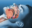 Oral AD109 improves sleep apnea severity but tolerability remains a challenge