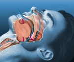 Oral AD109 improves sleep apnea severity but tolerability remains a challenge