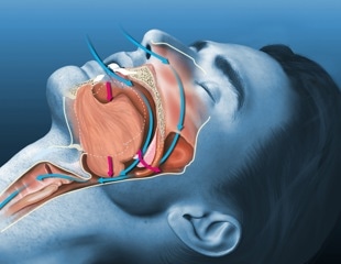 Oral AD109 improves sleep apnea severity but tolerability remains a challenge