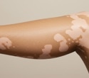 Diet and inflammation may play a role in progressive vitiligo