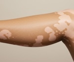 Diet and inflammation may play a role in progressive vitiligo