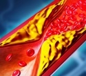 One-time gene editing cuts LDL cholesterol in early hypercholesterolemia trial