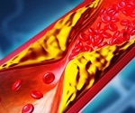 One-time gene editing cuts LDL cholesterol in early hypercholesterolemia trial