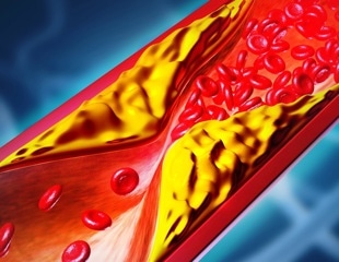 One-time gene editing cuts LDL cholesterol in early hypercholesterolemia trial